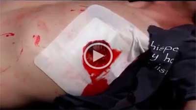 Control The Bleed Kit - Russell Wound Chest Seal
